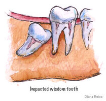 Wisdom teeth extraction